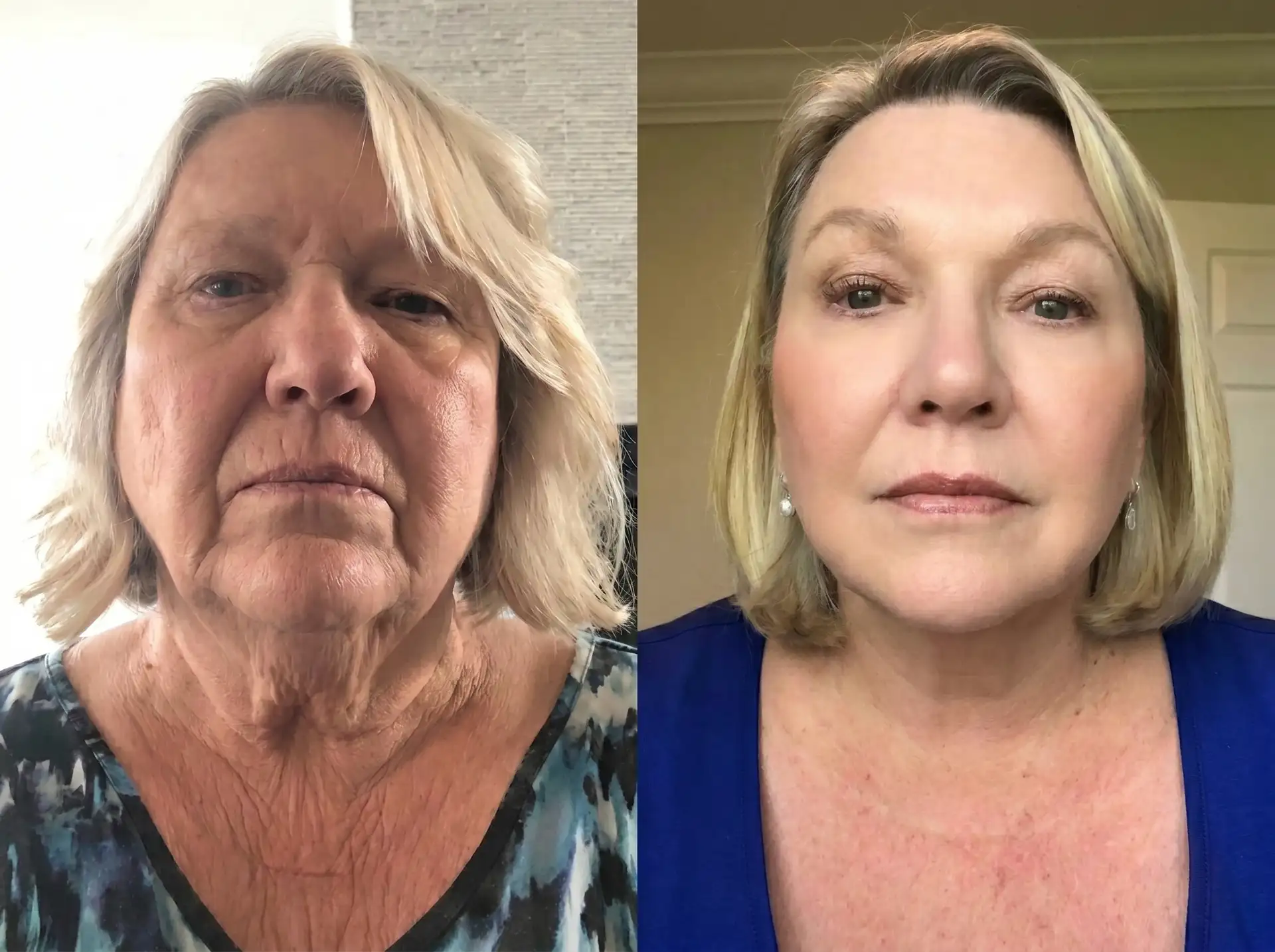 Jennifer, 58 - After 15 Months of Consistent Use
