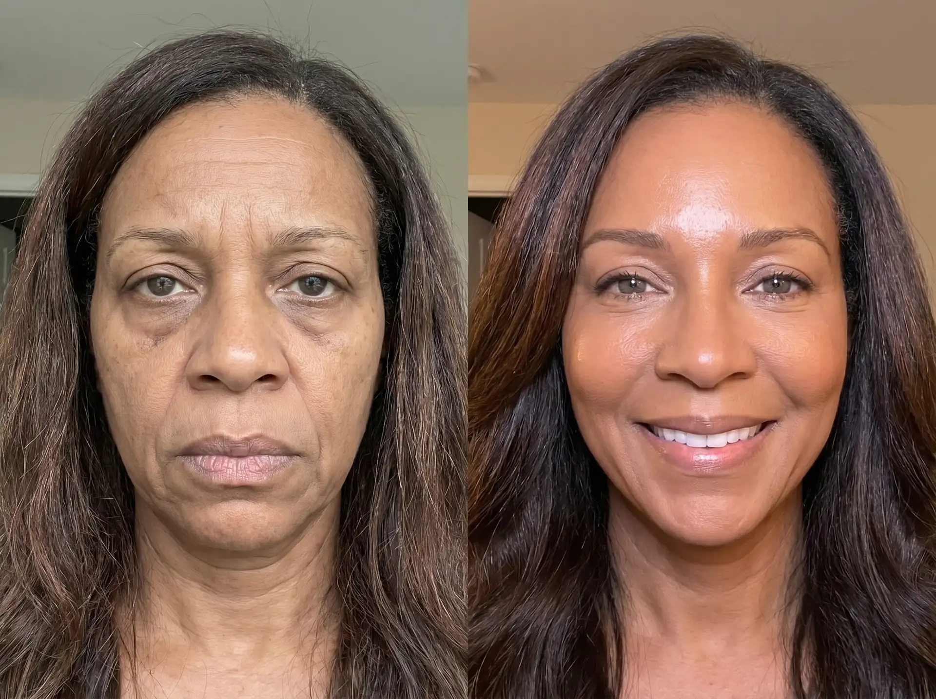 Sarah, 49 -
After 18 Months of Consistent Use